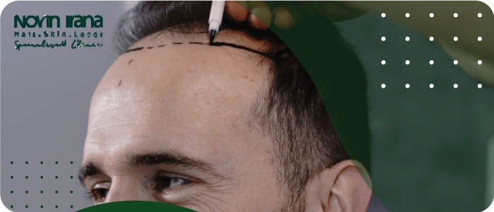 الأشخاص المناسبون لزراعة الشعر بطريقة DHI